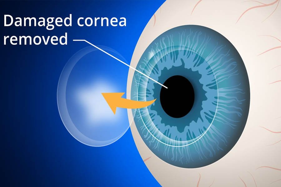 CORNEA TRANSPLANT