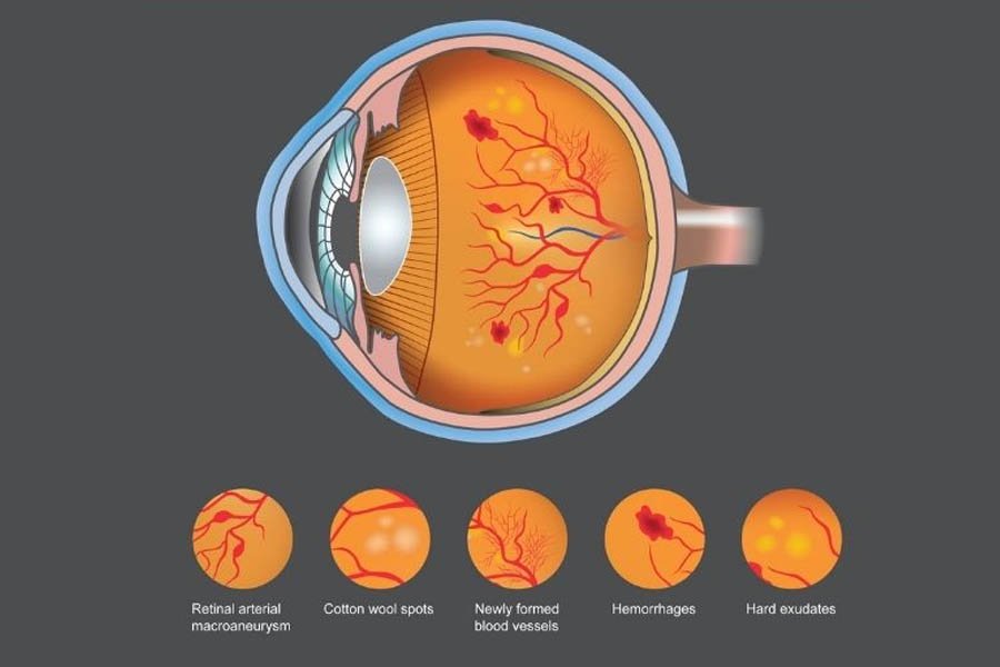 DIABETIC RETINOPATHY TREATMENT