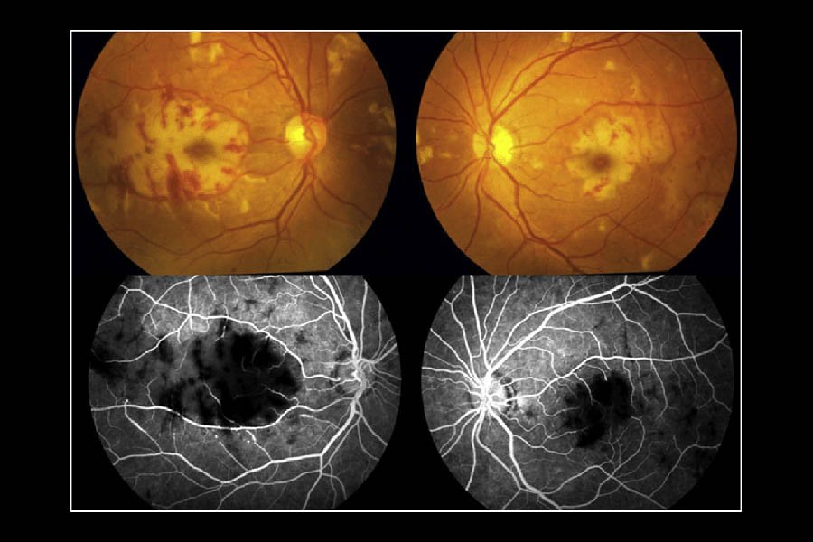 Fundus Fluorescein Angiography (FFA)