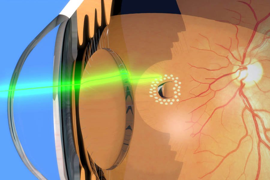 GREEN LASER (RETINAL LASER)