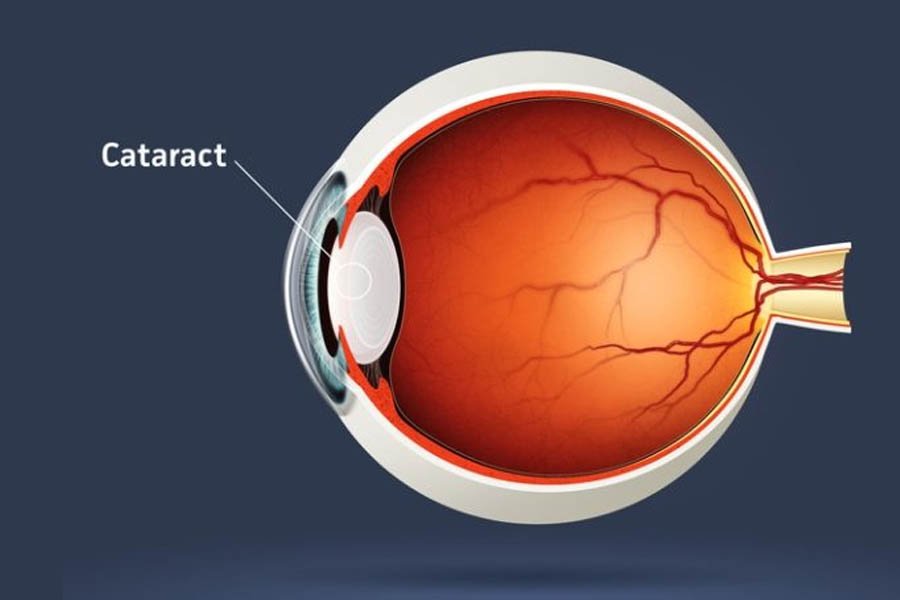 MICS- Microincision Cataract Surgery