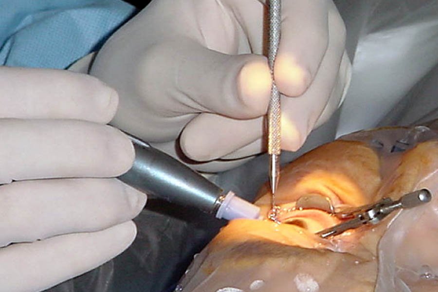 PHACO SURGERY