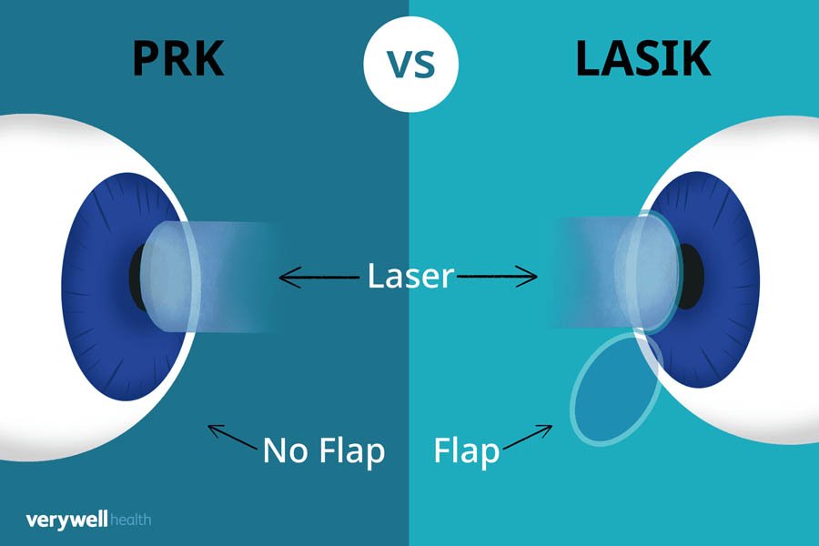 PRK LASIK