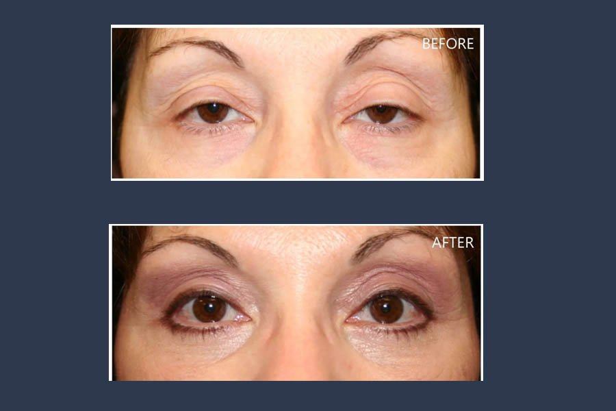 PTOSIS SURGERY