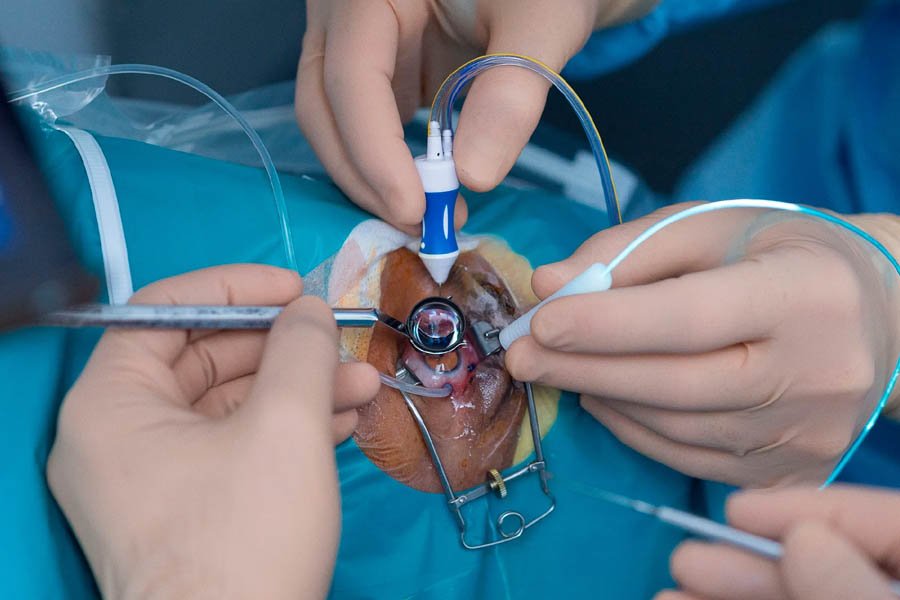 RETINAL DETACHMENT SURGERY