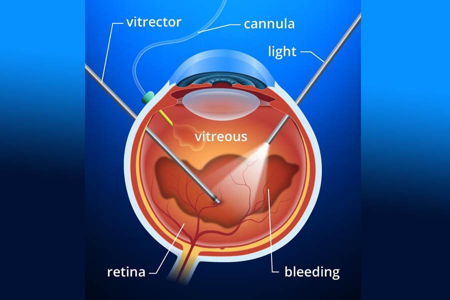 VITREOUS HEMORRHAGE SURGERY